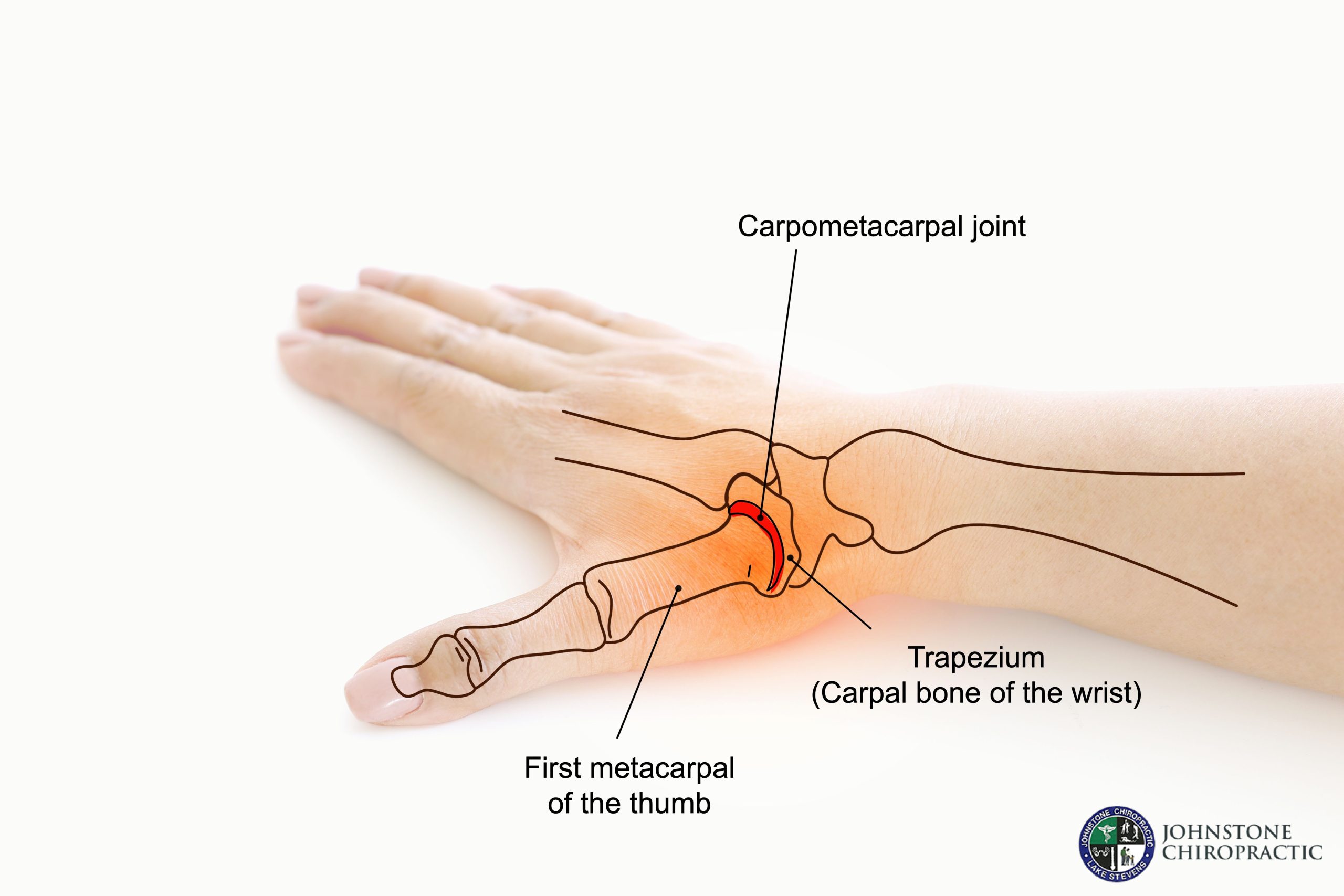 Where’s the Most Trusted, Reliable Place to Go for Chiropractic Treatment for Carpel Tunnel Syndrome in Mill Creek?