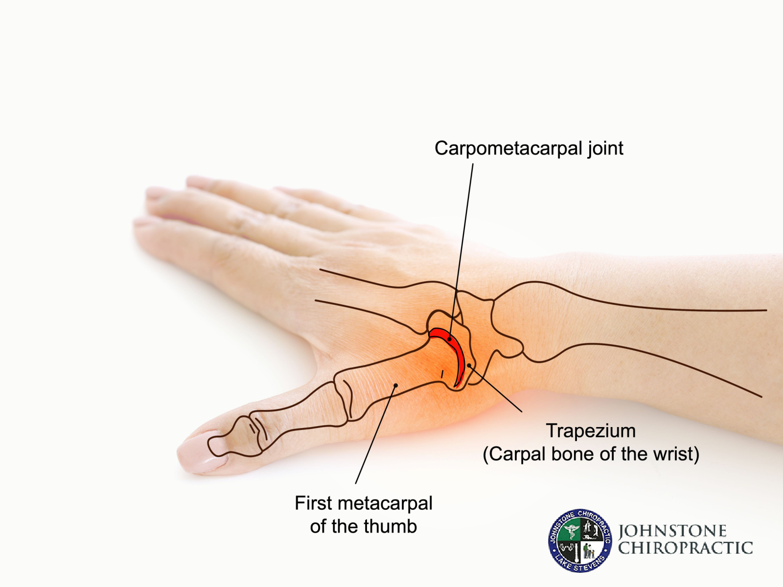 Find Relief for Carpal Tunnel Syndrome with Effective, Holistic Chiropractic Care